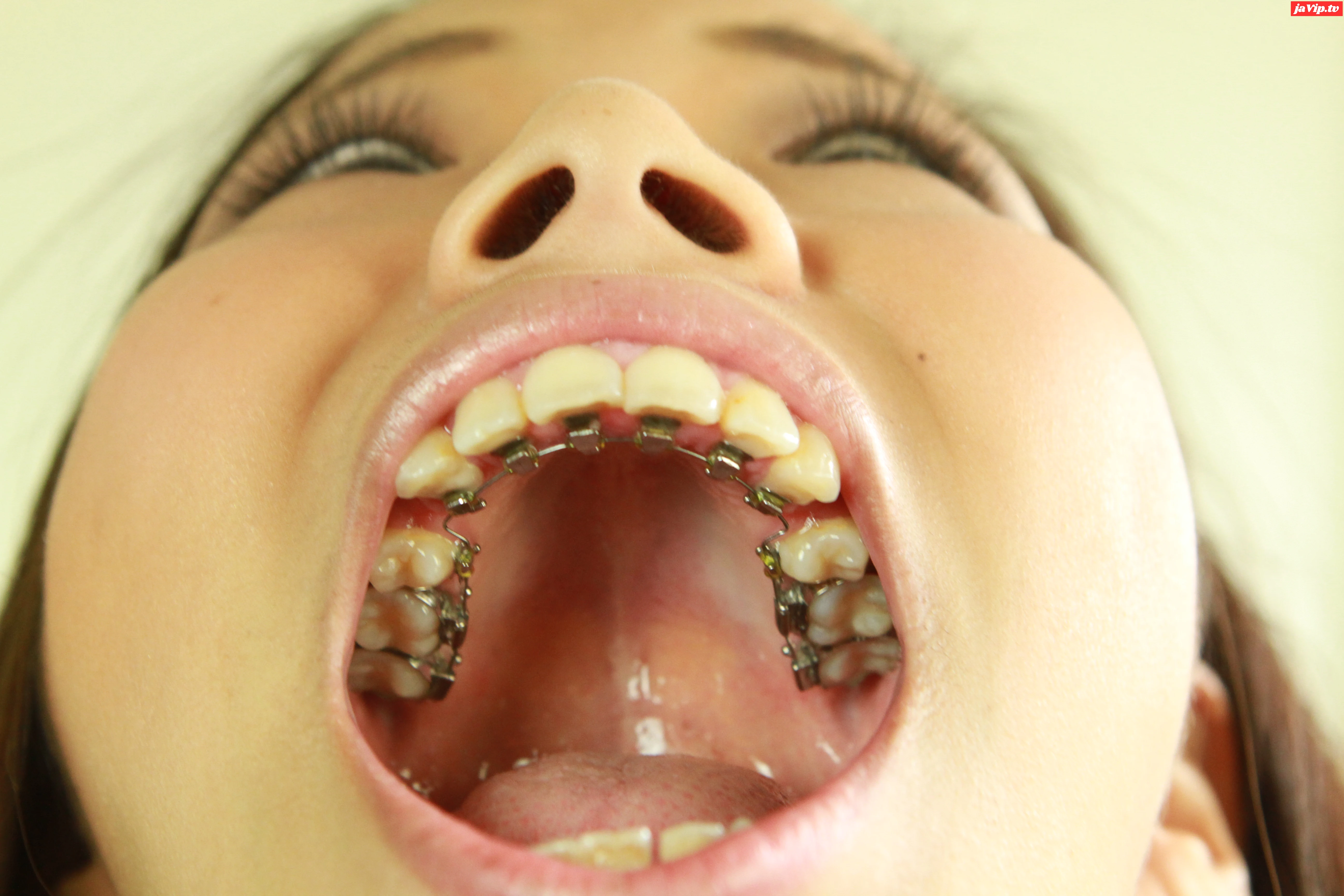 fc2ppv-4130110 - 歯観察　安里泉水ちゃんの、私、矯正中なんです - FC2PPV動画をオンラインで視聴 - jaVip