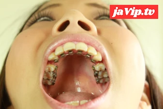 fc2ppv-4130110 - 歯観察　安里泉水ちゃんの、私、矯正中なんです